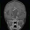 16A4 Craniopharyngioma (Case 16) T1 W 2 - Copy - Copy