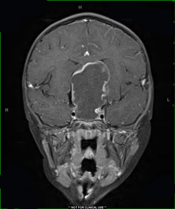 16A4 Craniopharyngioma (Case 16) T1 W 2 - Copy - Copy