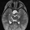 16A6 Craniopharyngioma (Case 16) T2 W 1 - Copy - Copy