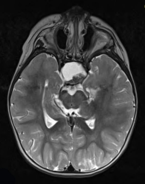 16A6 Craniopharyngioma (Case 16) T2 W 1 - Copy - Copy