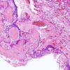 17A1 Craniopharyngioma (Case 17) H&E 4