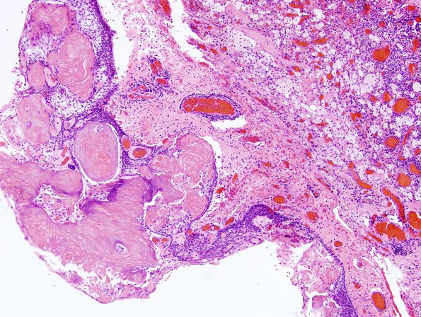 17A1 Craniopharyngioma (Case 17) H&E 4