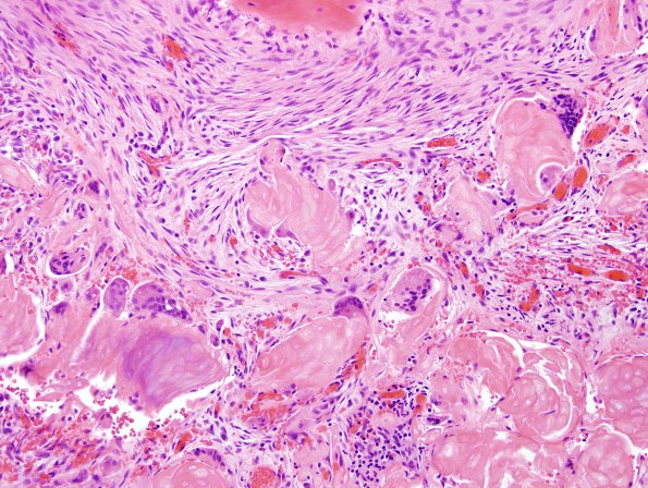 17A2 Craniopharyngioma (Case 17) H&E 3