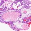 17A6 Craniopharyngioma (Case 18) H&E3