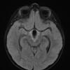 18A2 Craniopharyngioma, Adamantinomatous (Case 18) FLAIR 2 - Copy - Copy