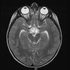 18A3 Craniopharyngioma, Adamantinomatous (Case 18) T2 1 - Copy - Copy