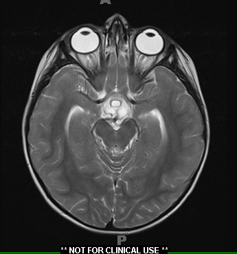 18A3 Craniopharyngioma, Adamantinomatous (Case 18) T2 1 - Copy - Copy