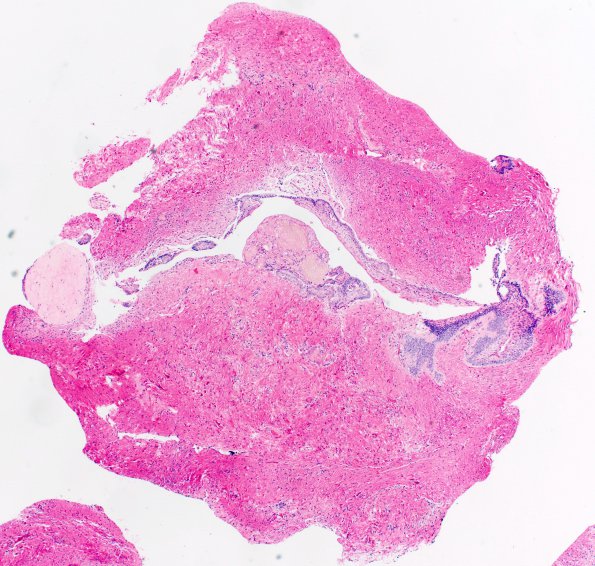 18B1 Craniopharyngioma, Adamantinomatous (Case 18) 20X 2