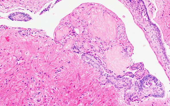 18B2 Craniopharyngioma, Adamantinomatous (Case 19) 20X 3