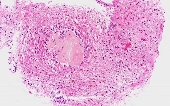 18B3 Craniopharyngioma, Adamantinomatous (Case 18) 20X