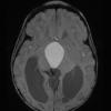 1A1 Cranio Rx 3 yr prior Case 1) ) Mag images 1 - Copy