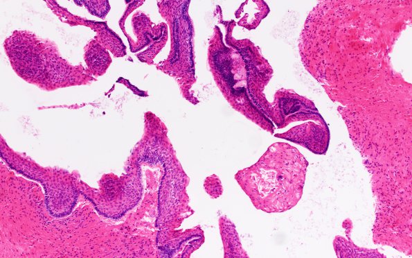 1C Craniopharyngioma, H&E (Case 1)  10X