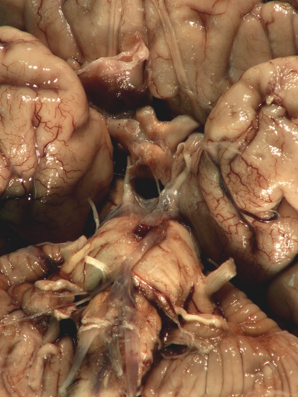 1D1 Cranio & radiation Rx 3 yr prior (Case 1) 2