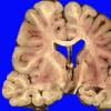 1D2 Cranio & radiation Rx 3 yr prior Case 1) 4