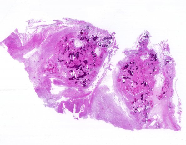 1E2 Cranio & radiation Rx 3 yr prior Case 1) N12 H&E WM