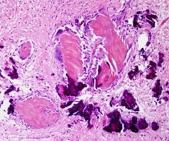 1E3 Cranio & radiation Rx 3 yr prior Case 1) N12 H&E 4.jpg