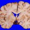 20A2 Craniopharyngioma (Case 20) 6 copy