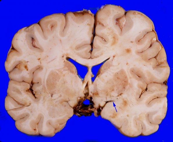 20A2 Craniopharyngioma (Case 20) 6 copy