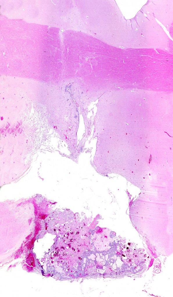 20B1 Craniopharyngioma (Case 20) WM