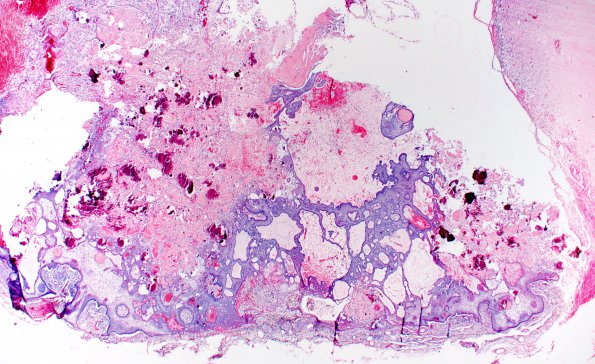 20B2 Craniopharyngioma (Case 20) 2X