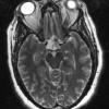 2A1 Craniopharyngioma, adamantinomatous (Case 2) T2 W 1 - Copy - Copy