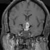 2A2 Craniopharyngioma, adamantinomatous (Case 2) T1 W 1 - Copy - Copy