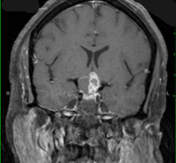 2A2 Craniopharyngioma, adamantinomatous (Case 2) T1 W 1 - Copy - Copy