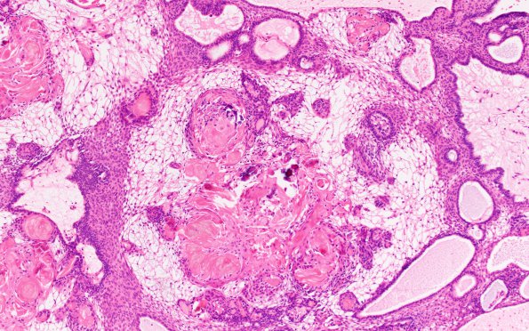 2B2 Craniopharyngioma, adamantinomatous (Case 2) H&E 10X