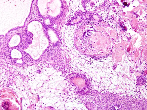 2B4 Craniopharyngioma, adamantinomatous (Case 2) H&E 1.jpg