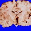 3A3 Craniopharyngioma (Case 3) 9