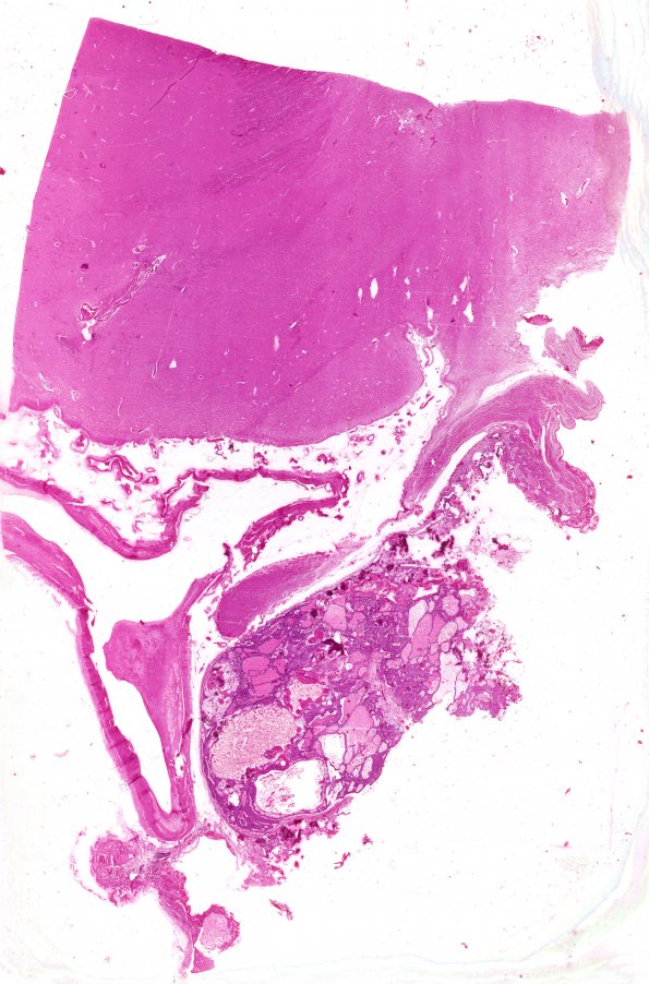 3B1 Craniopharyngioma, adult (Case 3) H&E whole mount