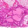 3B2 Craniopharyngioma, adult (Case 3) H&E 4X