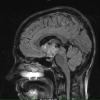 4A1 Craniopharyngioma (Case 4) T2 FLAIR 1 - Copy