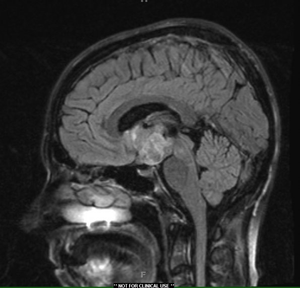 4A1 Craniopharyngioma (Case 4) T2 FLAIR 1 - Copy