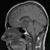 4A2 Craniopharyngioma (Case 4) T1 1 - Copy