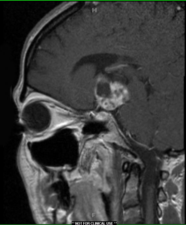 4A3 Craniopharyngioma (Case 4) T1 with contrast 2A - Copy