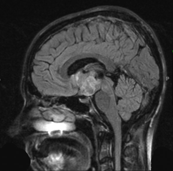 4A4 Craniopharyngioma (Case 4) T2 2 - Copy