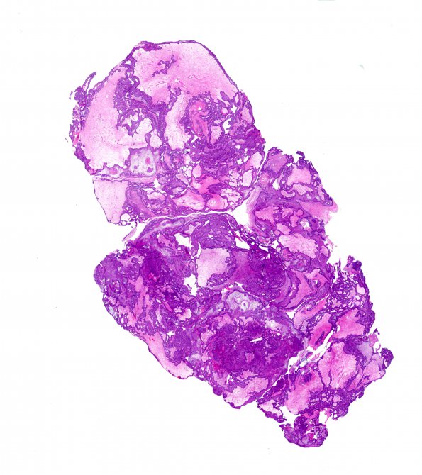 4B1 Craniopharyngioma (Case 4) H&E WM