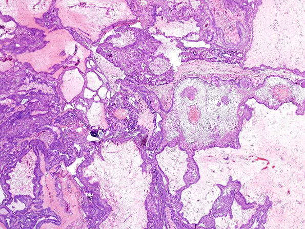 4B2 Craniopharyngioma (Case 4) H&E 1.jpg