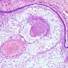 4B3 Craniopharyngioma (Case 4) H&E 3.jpg