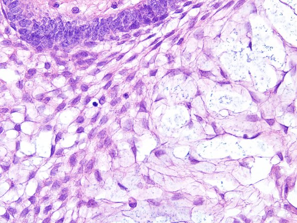 4B5 Craniopharyngioma (Case 4) H&E 7.jpg