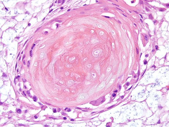 4B6 Craniopharyngioma (Case 4) H&E 8.jpg