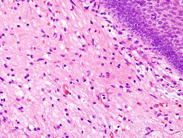 4B7 Craniopharyngioma (Case 4) H&E 13.jpg