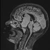 5A1 Craniopharyngioma, adamantinomatous (Case 5) FLAIR - Copy - Copy