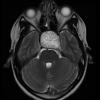 5A4 Craniopharyngioma, adamantinomatous (Case 5) (NP16-543) T2 1 -  - Copy - Copy