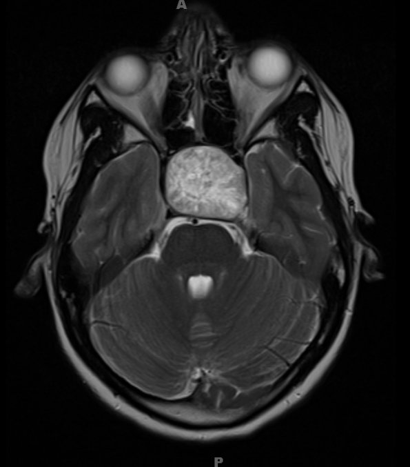 5A4 Craniopharyngioma, adamantinomatous (Case 5) (NP16-543) T2 1 -  - Copy - Copy