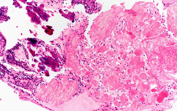 5B2 Craniopharyngioma, adamantinomatous (Case 5) H&E 20X 2