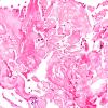 5B3 Craniopharyngioma, adamantinomatous (Case 5) H&E 40X