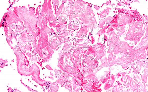 5B3 Craniopharyngioma, adamantinomatous (Case 5) H&E 40X