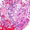 5B7 Craniopharyngioma (Case 5) H&E xanthogranulomatous inflammation 3 b